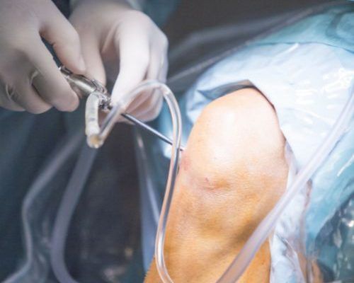 cirugia operacion rodilla las palmas
